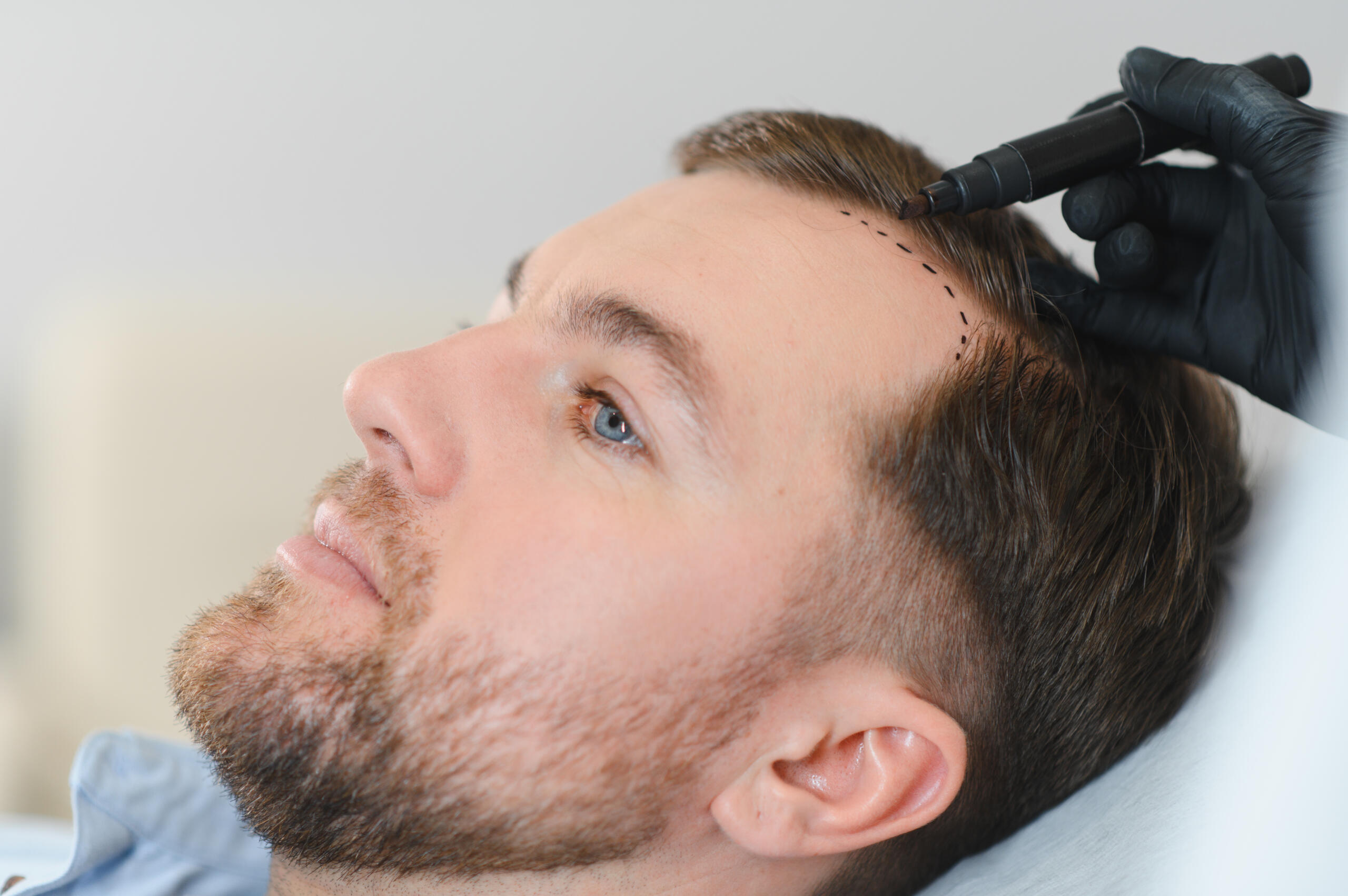 FUE Sapphire Hair Transplant